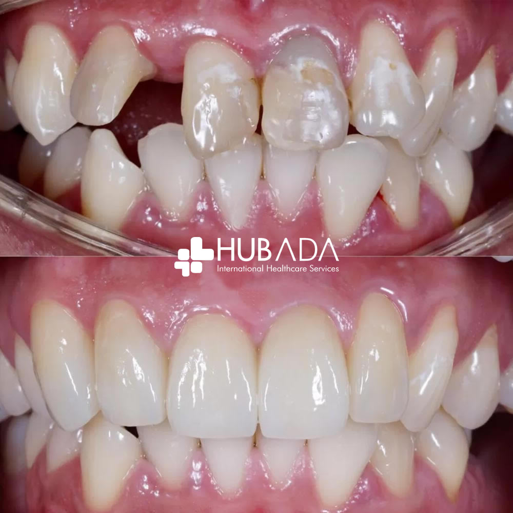 Best Dental Clinic in Turkey - Hubada Health